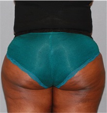 Buttock Lift with Augmentation After Photo by Ramin Behmand, MD; Nashville, TN - Case 31580
