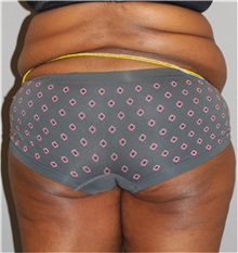 Buttock Lift with Augmentation Before Photo by Ramin Behmand, MD; Nashville, TN - Case 31580