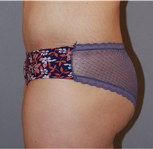 Buttock Lift with Augmentation After Photo by Ramin Behmand, MD; Nashville, TN - Case 31581