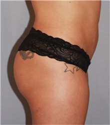 Buttock Lift with Augmentation After Photo by Ramin Behmand, MD; Nashville, TN - Case 31582