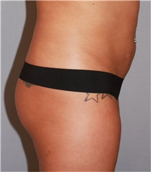Buttock Lift with Augmentation Before Photo by Ramin Behmand, MD; Nashville, TN - Case 31582