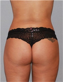 Buttock Lift with Augmentation After Photo by Ramin Behmand, MD; Nashville, TN - Case 31582