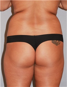 Buttock Lift with Augmentation Before Photo by Ramin Behmand, MD; Nashville, TN - Case 31582
