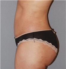 Buttock Lift with Augmentation After Photo by Ramin Behmand, MD; Nashville, TN - Case 31586