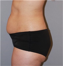 Buttock Lift with Augmentation Before Photo by Ramin Behmand, MD; Nashville, TN - Case 31586