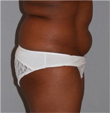 Buttock Lift with Augmentation Before Photo by Ramin Behmand, MD; Nashville, TN - Case 31587