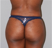 Buttock Lift with Augmentation After Photo by Ramin Behmand, MD; Nashville, TN - Case 31587