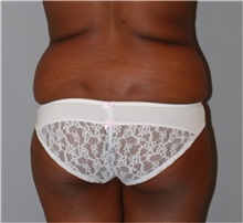 Buttock Lift with Augmentation Before Photo by Ramin Behmand, MD; Nashville, TN - Case 31587