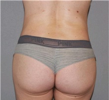 Buttock Lift with Augmentation After Photo by Ramin Behmand, MD; Nashville, TN - Case 31589