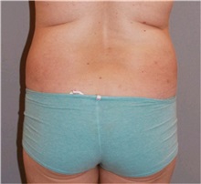 Buttock Lift with Augmentation Before Photo by Ramin Behmand, MD; Nashville, TN - Case 31589