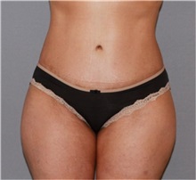 Liposuction After Photo by Ramin Behmand, MD; Nashville, TN - Case 31591