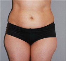Liposuction Before Photo by Ramin Behmand, MD; Nashville, TN - Case 31591