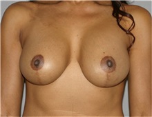 Breast Lift After Photo by Ramin Behmand, MD; Nashville, TN - Case 31596