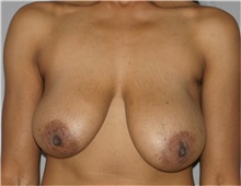 Breast Lift Before Photo by Ramin Behmand, MD; Nashville, TN - Case 31596