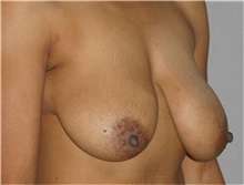 Breast Lift Before Photo by Ramin Behmand, MD; Nashville, TN - Case 31597