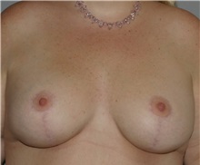 Breast Lift After Photo by Ramin Behmand, MD; Nashville, TN - Case 31608