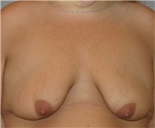 Breast Lift Before Photo by Ramin Behmand, MD; Nashville, TN - Case 31608