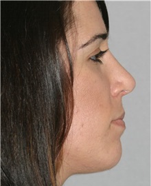 Rhinoplasty After Photo by Ramin Behmand, MD; Nashville, TN - Case 31609