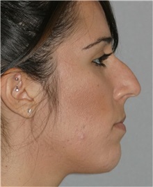Rhinoplasty Before Photo by Ramin Behmand, MD; Nashville, TN - Case 31609