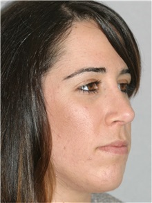 Rhinoplasty After Photo by Ramin Behmand, MD; Nashville, TN - Case 31609