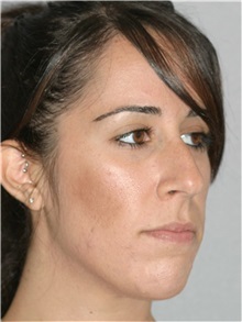 Rhinoplasty Before Photo by Ramin Behmand, MD; Nashville, TN - Case 31609
