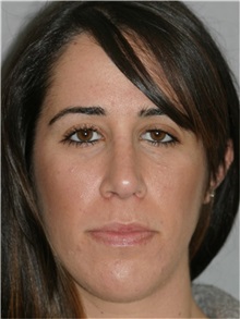 Rhinoplasty After Photo by Ramin Behmand, MD; Nashville, TN - Case 31609
