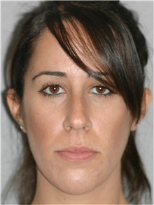 Rhinoplasty Before Photo by Ramin Behmand, MD; Nashville, TN - Case 31609