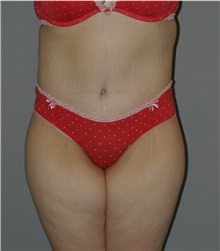 Body Lift After Photo by Ramin Behmand, MD; Nashville, TN - Case 31613