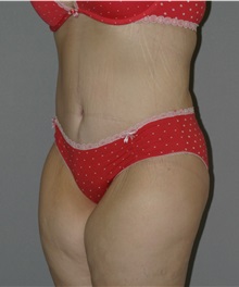 Body Lift After Photo by Ramin Behmand, MD; Nashville, TN - Case 31613