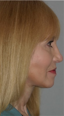 Facelift After Photo by Ramin Behmand, MD; Nashville, TN - Case 31614