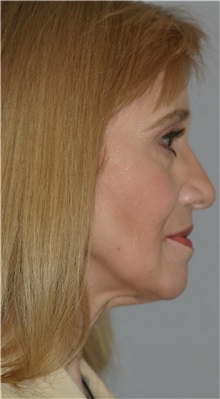 Facelift Before Photo by Ramin Behmand, MD; Nashville, TN - Case 31614