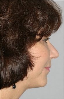 Facelift After Photo by Ramin Behmand, MD; Nashville, TN - Case 31615
