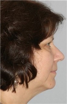Facelift Before Photo by Ramin Behmand, MD; Nashville, TN - Case 31615