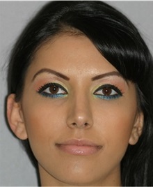Rhinoplasty After Photo by Ramin Behmand, MD; Nashville, TN - Case 31645