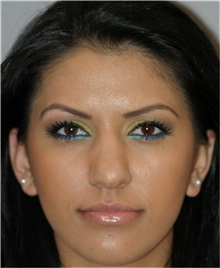Rhinoplasty Before Photo by Ramin Behmand, MD; Nashville, TN - Case 31645