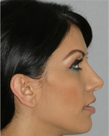 Rhinoplasty After Photo by Ramin Behmand, MD; Nashville, TN - Case 31645