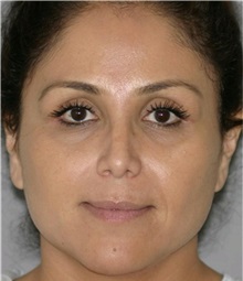Rhinoplasty After Photo by Ramin Behmand, MD; Nashville, TN - Case 31647