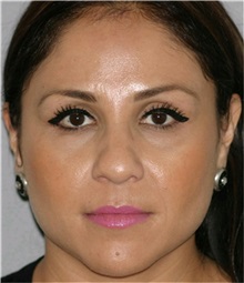 Rhinoplasty Before Photo by Ramin Behmand, MD; Nashville, TN - Case 31647
