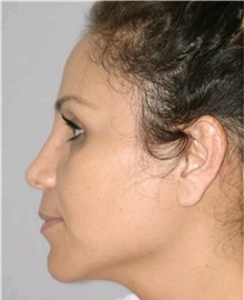 Rhinoplasty After Photo by Ramin Behmand, MD; Nashville, TN - Case 31647