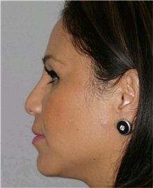 Rhinoplasty Before Photo by Ramin Behmand, MD; Nashville, TN - Case 31647