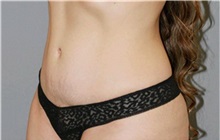Tummy Tuck After Photo by Ramin Behmand, MD; Nashville, TN - Case 31707