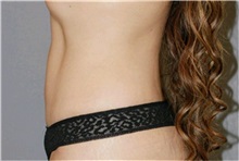 Tummy Tuck After Photo by Ramin Behmand, MD; Nashville, TN - Case 31707