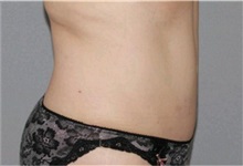Tummy Tuck After Photo by Ramin Behmand, MD; Nashville, TN - Case 32228