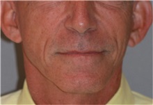 Facelift After Photo by Ramin Behmand, MD; Nashville, TN - Case 32230