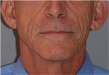 Facelift Before Photo by Ramin Behmand, MD; Nashville, TN - Case 32230