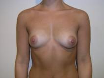 Breast Augmentation Before Photo by Joseph Fodero, MD; Florham Park, NJ - Case 7264