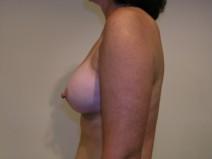 Breast Augmentation After Photo by Joseph Fodero, MD; Florham Park, NJ - Case 7284