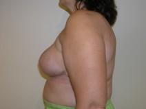 Breast Reduction After Photo by Joseph Fodero, MD; Florham Park, NJ - Case 7287