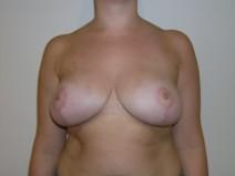 Breast Reduction After Photo by Joseph Fodero, MD; Florham Park, NJ - Case 7288