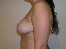 Breast Reduction After Photo by Joseph Fodero, MD; Florham Park, NJ - Case 7288